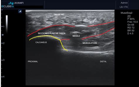 Ultrasound-Guided Plantar Fascia Release with Needle: A Novel Surgical Technique