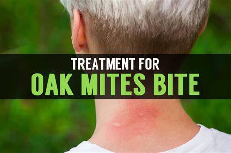 Oak Mites Treatment and Signs of Mite Bites