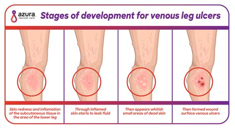 Icd 10 Code For Bilateral Venous Stasis Ulcers