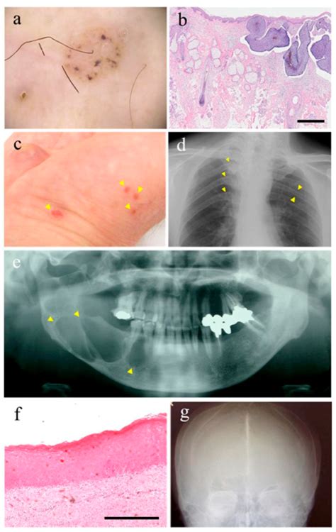 IJMS | Free Full-Text | Gorlin Syndrome: Recent Advances in Genetic ...