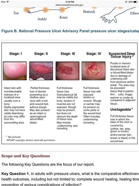 ulcer stages Nursing School Studying, Medical School, Pressure Ulcer Staging, Wounds Nursing ...