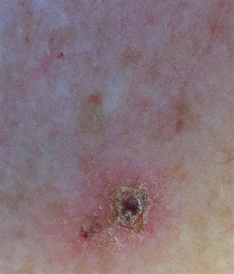 Morgellons Disease Pictures | TimeSocket