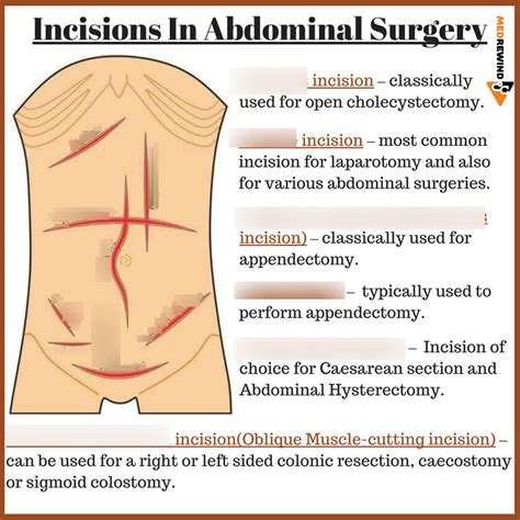 Incisions/abdominal Diagram | Quizlet