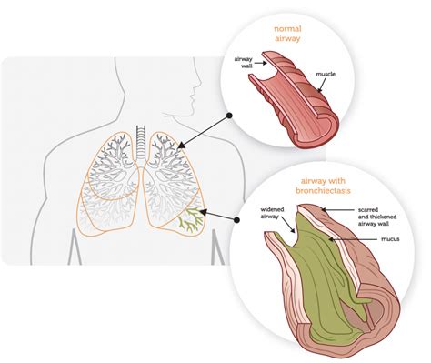 Pathophysiology - Bronchiectasis