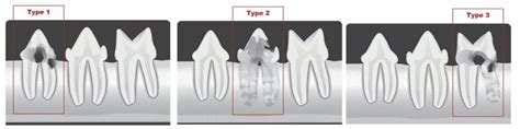 Feline Tooth Resorption: Treatment Options - Veterinary Medicine at ...