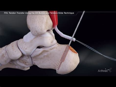 FHL Tendon Transfer Using the DX Button and Tension-Slide Technique - YouTube