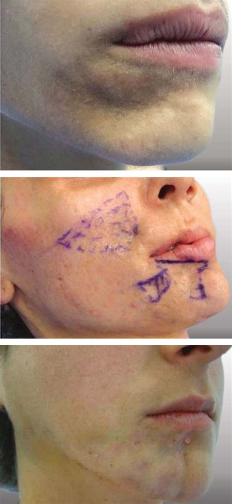 Cases of scleroderma lesions and atrophy on the face | Download Scientific Diagram