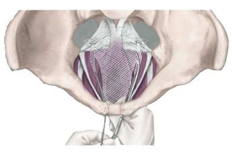 Bladder Sling Complications | Pain, Mesh Erosion & Perforation