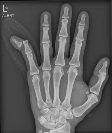 Compound Fracture X Ray