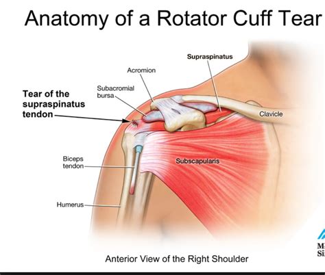 Anatomy of a rotator cuff tear Archives - Arizona Institute for Sports, Knees and Shoulders