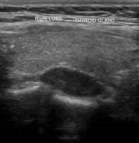 Parathyroid adenoma causes, symptoms, diagnosis, treatment & prognosis