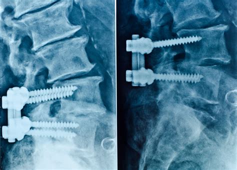 Alternative to Spinal Fusion Surgery | Premia Spine