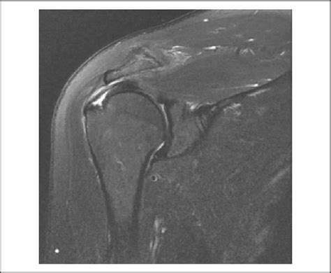 Partial Thickness Rotator Cuff Tear Mri