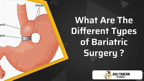 What are the different types of bariatric surgery