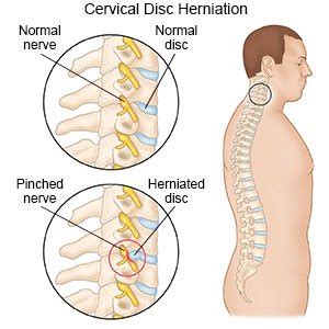 Cervical Disc Herniation (Discharge Care)