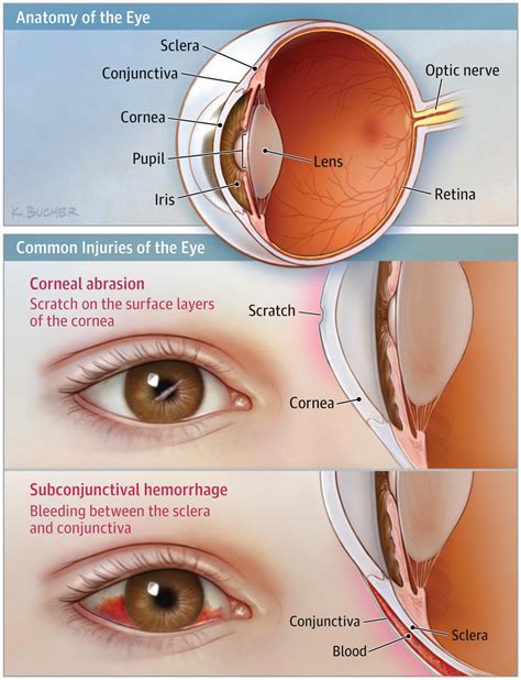 Injury to the Eye | Ophthalmology | JAMA | JAMA Network