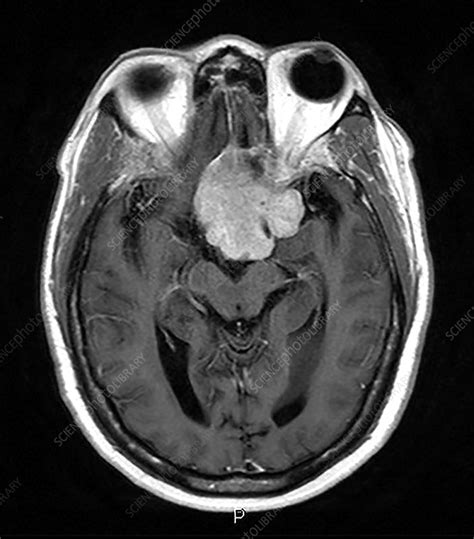 Planum Sphenoidale Meningioma - Stock Image - C043/2777 - Science Photo Library