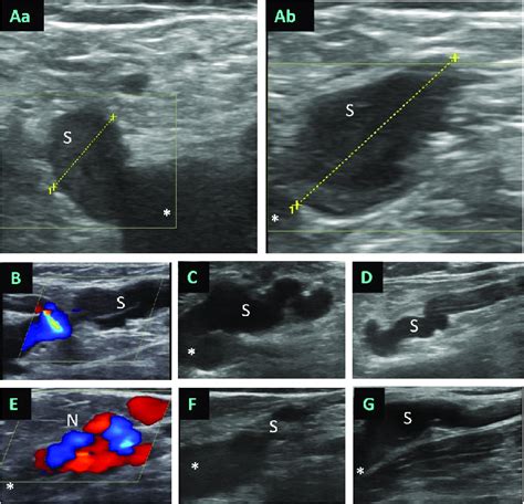 Morphology of SFJ recurrences. Representative duplex ultrasound images ...