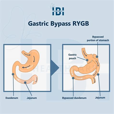 Roux-en-Y Gastric Bypass: Surgery to Recovery, Complete Guide