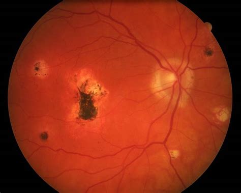 Histoplasmosis | Australia| PDF | PPT| Case Reports | Symptoms | Treatment