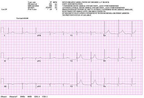 Aquila's Blog: heart block ecg