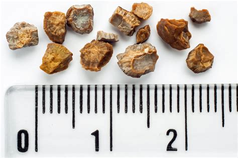 Kidney Stones: What are They and How are They Treated? - Revere Health