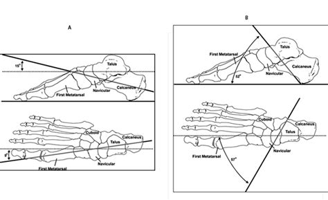 Midtarsal Joint Locking Mechanism - Center for Limb Loss and MoBility