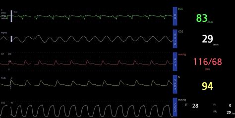 ETCO2 monitoring in ICU – capnography – All About Cardiovascular System ...