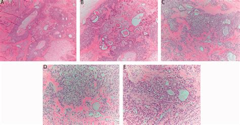 Tumor histology. A, H&E ×40 low-power view demonstrating an ...