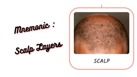 Scalp Anatomy Layers Mnemonic S Skin C Connective Gre - vrogue.co