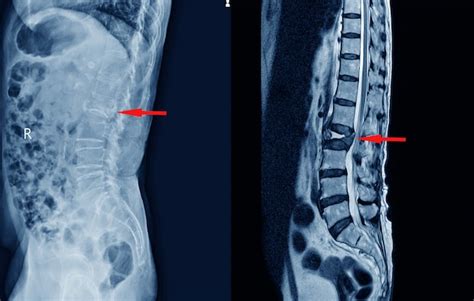 Premium Photo | Medical x-ray lumbar spine compression fracture on red arrow point