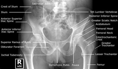 Pelvis radiograph | Radiología, Anatomía médica, Anatomía