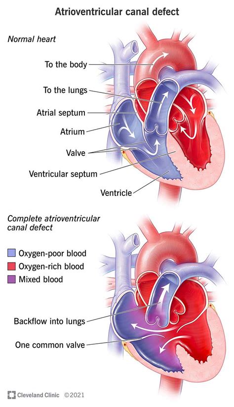 Atrioventricular Canal Defect (AVSD): Types & Prognosis