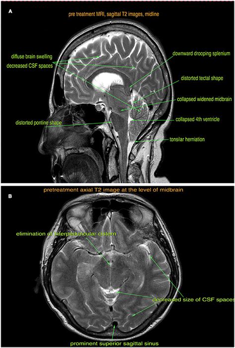 Frontiers | Spontaneous Intracranial Hypotension Presenting With Frontotemporal Dementia: A Case ...