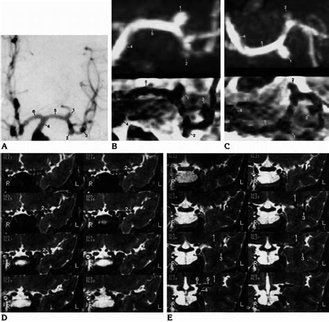 A , Anteroposterior view of left internal carotid angiogram shows three... | Download Scientific ...