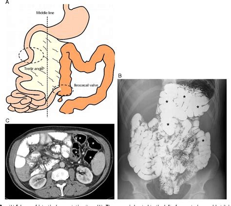 Figure 3 from Intestinal malrotation--volvulus: imaging findings. | Semantic Scholar