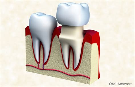 Six Reasons Why Your Crown Fell Off | Oral Answers