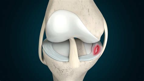 What Is a Meniscus Tear & How Can I Treat It? | NorthEast Spine & Sports Medicine