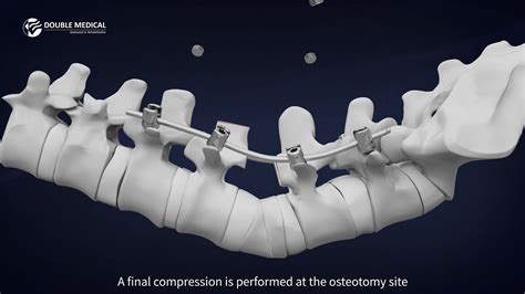 Pedicle Subtraction Osteotomy (PSO) Procedure with Double Medical PSO Instrument Set - YouTube