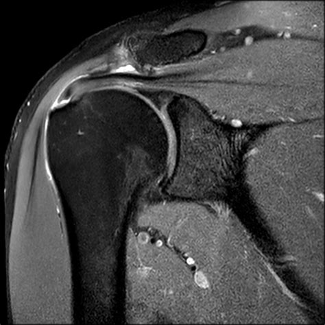 supraspinatus-partial-tear-with-subacromial-impingement - Witty, Pask ...