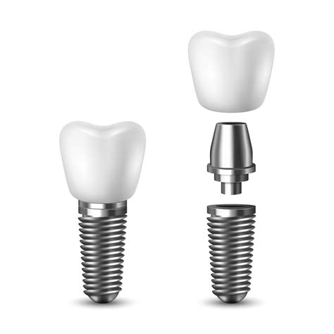 Dental Implants — Memphis Dentures and Implants