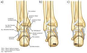 Subtalar joint arthritis: Causes, Symptoms, Diagnosis & Treatment