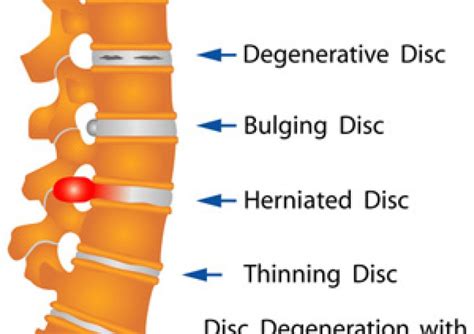 Common Causes of Back Pain | Proliance Orthopedic