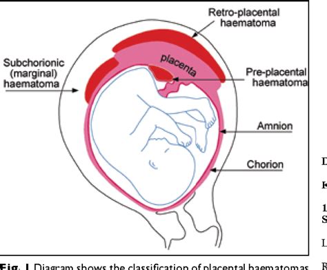 Figure 1 from Massive pre-placental and subchorionic haematoma ...