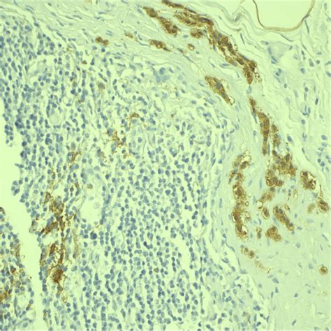Case 1: S-100 immunostain shows 0.4 mm focus of small bland appearing... | Download Scientific ...