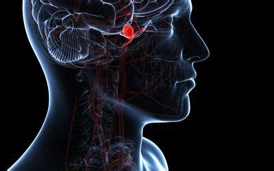 Damage to the Corona Radiata After Stroke