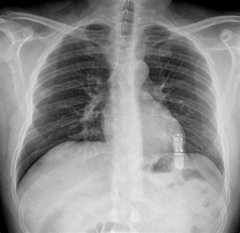 Implanted Cardiac Event Recorder (Loop Recorder) - MR IMPLANT