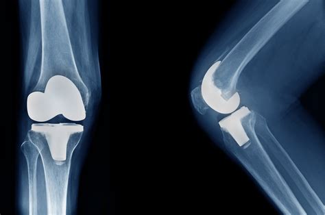 Revision Total Knee Replacement - New York Bone & Joint Specialists