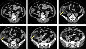 Acute appendicitis: transverse retrocaecal appendix – Radiology Cases