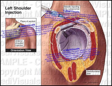 Left Shoulder Injection (Subacromial Bursa) - Medivisuals Inc.